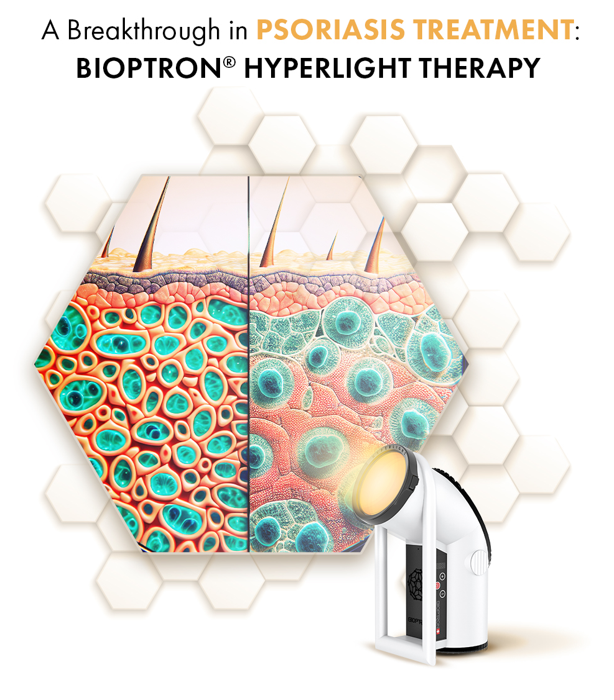 BIOPTRON® Hyperlight Therapy in the Treatment of Psoriasis