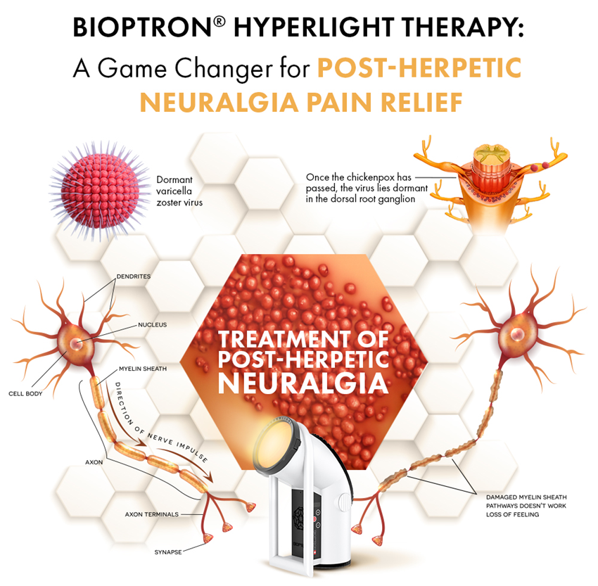 BIOPTRON® Hyperlight Therapy in the Treatment of  Post-Herpetic Neuralgia